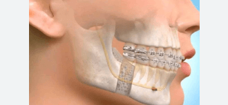 Maxillary Oral Surgeon